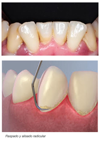 Gingivitis y Periodontitis