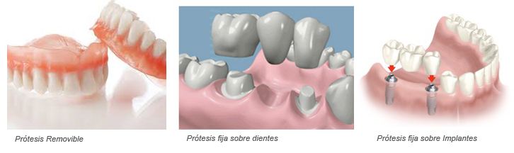 Protesis varias