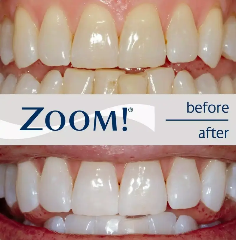 Antes y después Blanqueamiento Dental