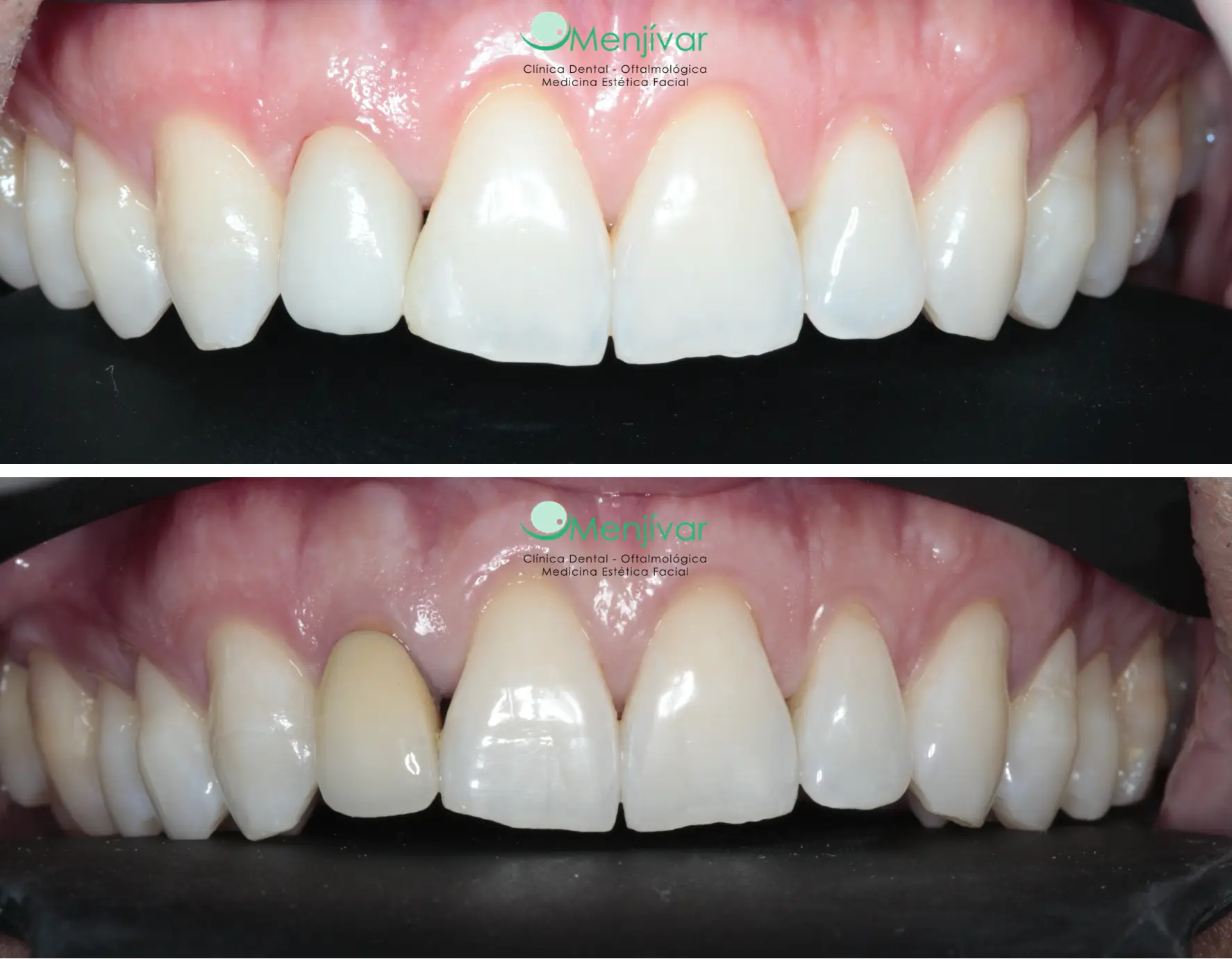 Antes y después de tratamiento con Carillas de Porcelana