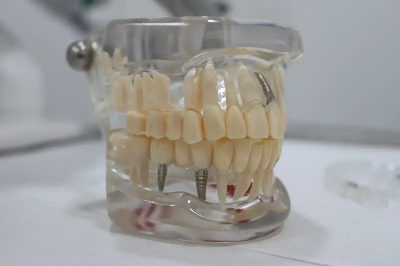 Muestra de Implante dental