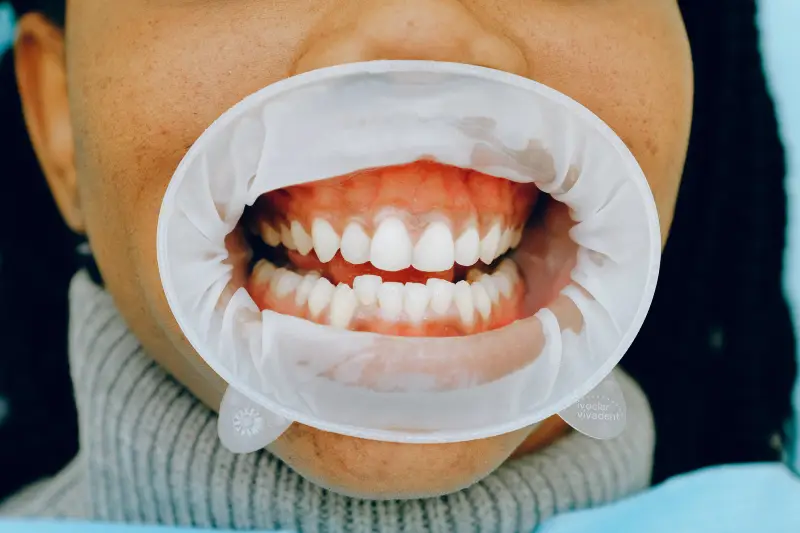 Tratamiento blanqueamiento dental