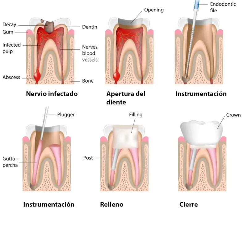 Fases de la endodoncia