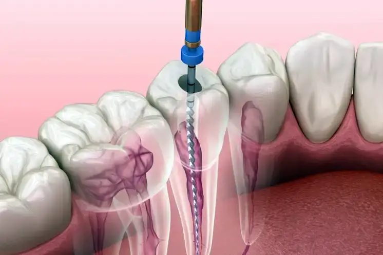 Endodoncia unirradicular