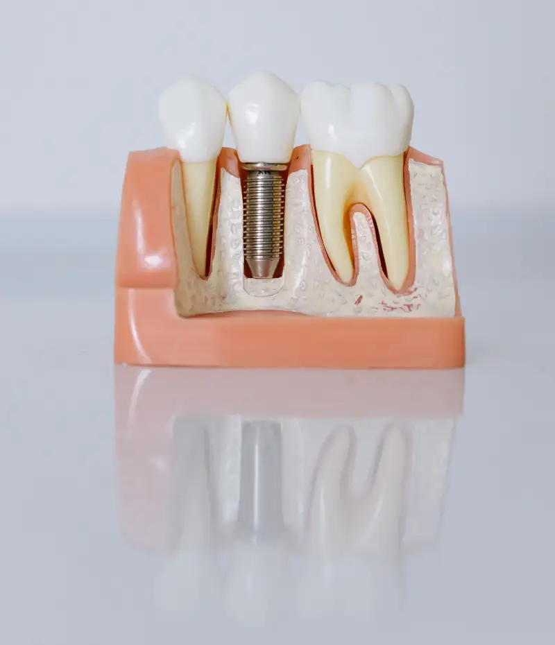 Implante dental