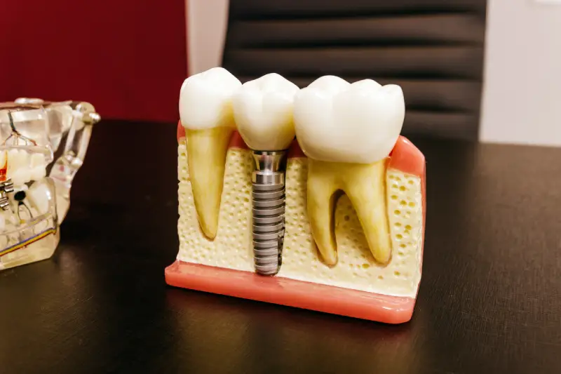 Maqueta de Implante dental