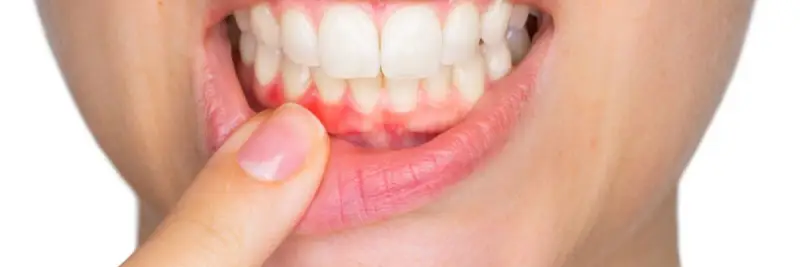 Periodoncia boca