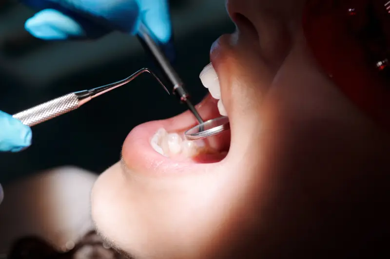 Tratamiento de la Periodontitis