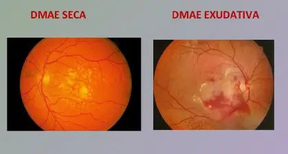 tratamiento de la DMAE